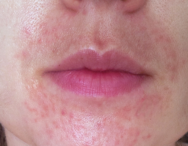 Simple Techniques To Handle Candida