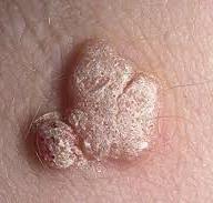 Warts