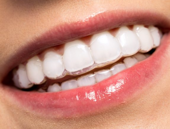 invisalign